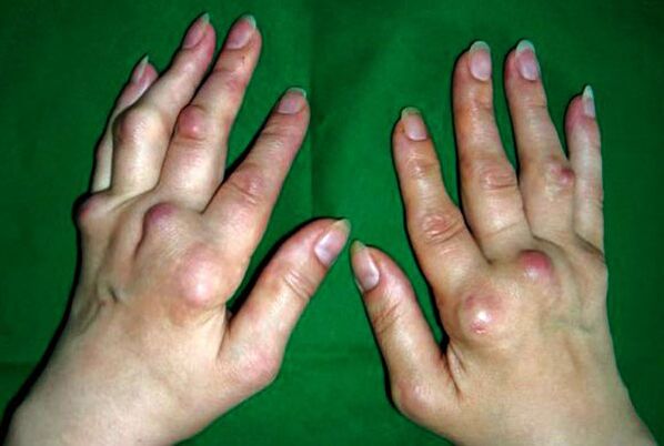 Hands affected by poliosteoarthritis deformance