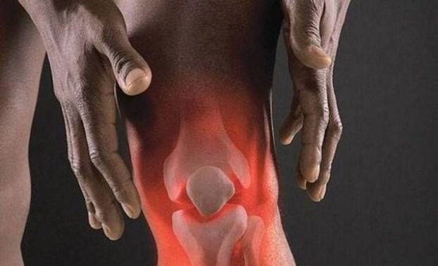 Arthrosis is associated with an inflammatory process in the knee joint